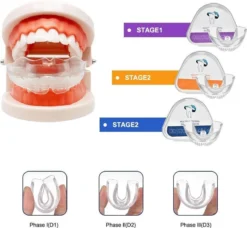SAMA Direct™ Rechte Tanden Zonder Beugel - Orthodontische Bitjes - Rechte Tanden Bitje - Beugel - Knarsbitje - Nachtbeugel - Knarsen Bitje - Rechte Tanden - Witte Tanden