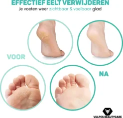 Alternative view of Vulpes BeautyCare® Elektrische Eelt Verwijderaar Pro – Stofzuigfunctie – 3 Snelheden – Inclusief 3 Vijlschijven & Borstel - USB-Oplaadbaar