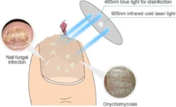 Alternative view of Anti Schimmelnagel Kalknagel Laserapparaat Om Zelf Te Behandelen, Veilig, Effectief, Snel En Pijnloos, Koude Laser Behandeling Voor Thuisgebruik, Voor Tenen En Vingers. Oplaadbaar.