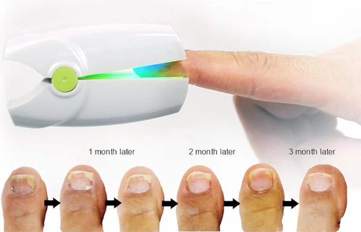 Anti Schimmelnagel Kalknagel Laserapparaat Om Zelf Te Behandelen, Veilig, Effectief, Snel En Pijnloos, Koude Laser Behandeling Voor Thuisgebruik, Voor Tenen En Vingers. Oplaadbaar. 3 Anti Schimmelnagel Kalknagel Laserapparaat Om Zelf Te Behandelen, Veilig, Effectief, Snel En Pijnloos, Koude Laser Behandeling Voor Thuisgebruik, Voor Tenen En Vingers. Oplaadbaar. - Afbeelding 3