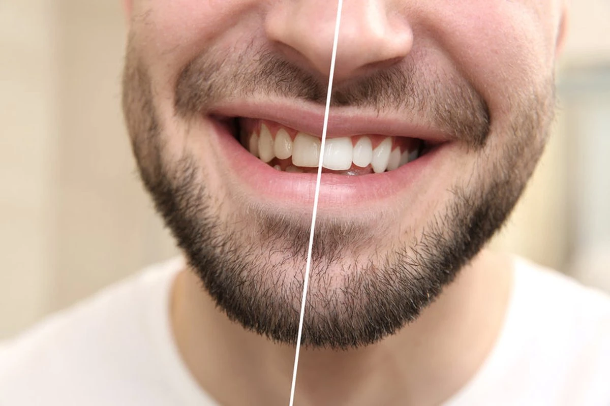 Moist-R Teeth Whitening Stick (2X) En 5 Refills - Thuis Tanden Bleken - Witte Tanden 6 Moist-R Teeth Whitening Stick (2X) En 5 Refills - Thuis Tanden Bleken - Witte Tanden - Afbeelding 6